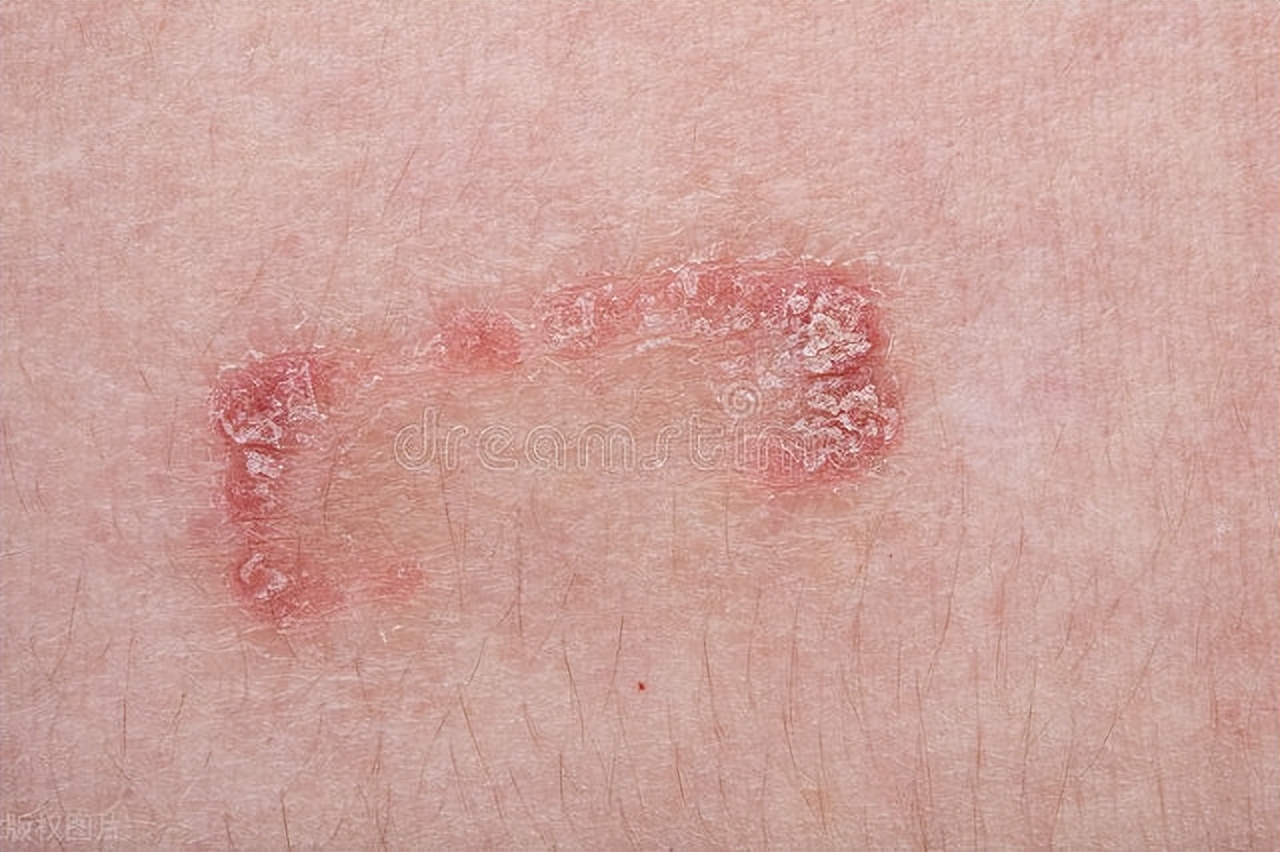 银屑病老是复发怎么办,银屑病光疗后会复发吗