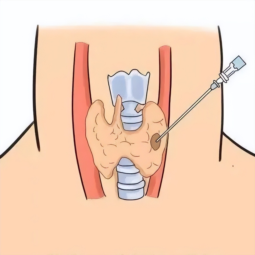 甲状腺癌是“懒癌”?别低估其破坏力