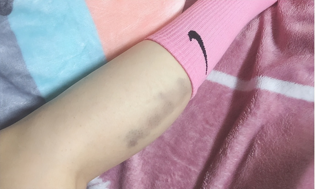 使用筋膜枪的好处和坏处,筋膜枪乱用有伤害吗