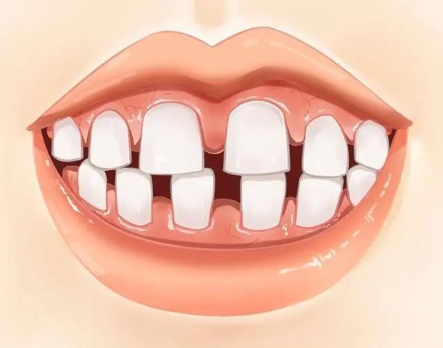 总塞牙怎么彻底解决,老是塞牙缝怎么修补最好