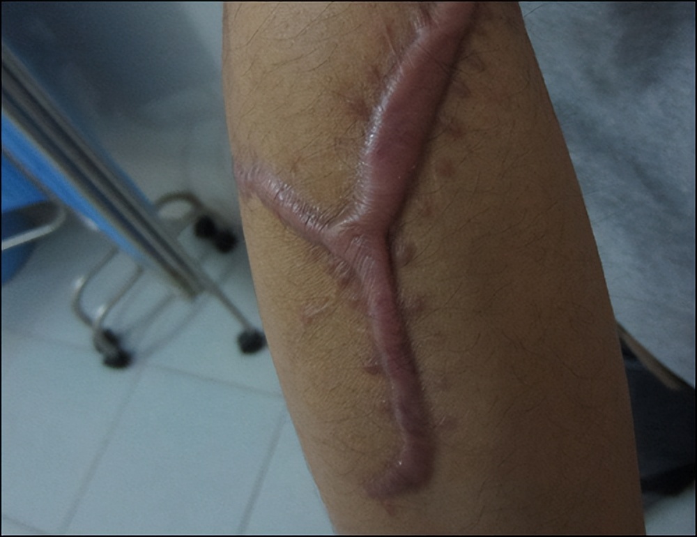 郑州市第一人民医院祛疤,郑州第二中医院治疤痕多少钱