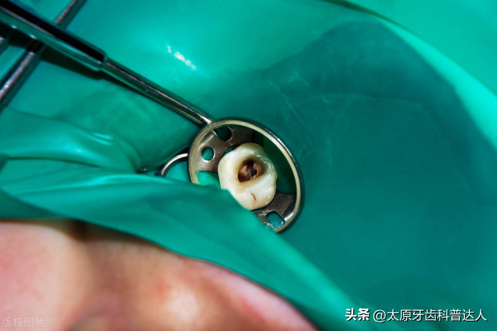 根管治疗后牙齿不咬东西也会酸,根管治疗后牙齿不戴牙冠可以吗