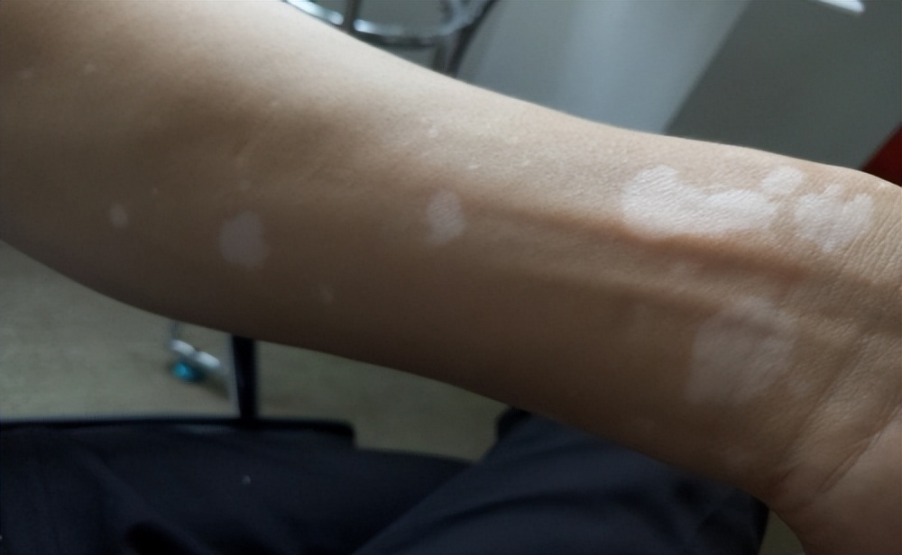 皮炎湿疹后留下的白斑是白癜风吗,湿疹后得的白癜风好治吗