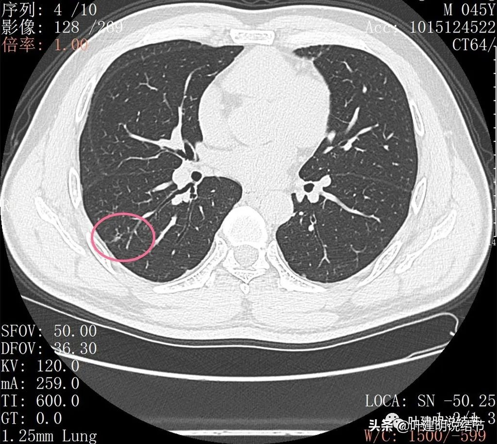 肺蜂窝状改变是肺癌吗,肺部陈旧灶与肿瘤怎么确诊