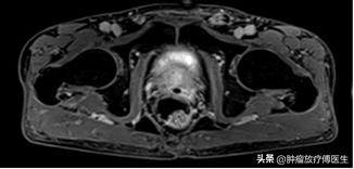前列腺癌9级需要做化疗么,山西肿瘤医院前列腺癌放射治疗