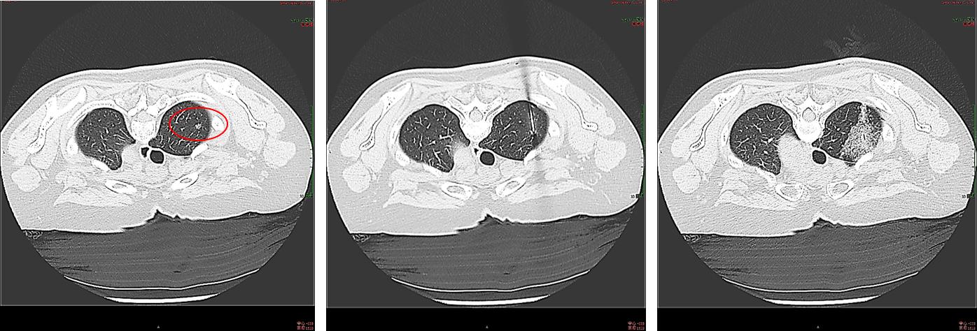 肺高危磨玻璃结节怎么治疗最好,肺磨玻璃结节影微创手术