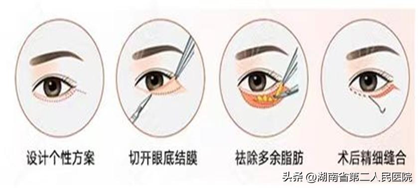 眼睛下面长了个小疙瘩可以切掉吗,眼睛长了个凸起的小包用手术吗
