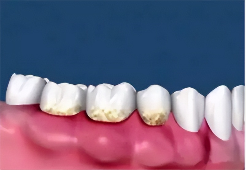 牙齿矫正过程口腔护理,口腔科普牙齿矫正的十大误区