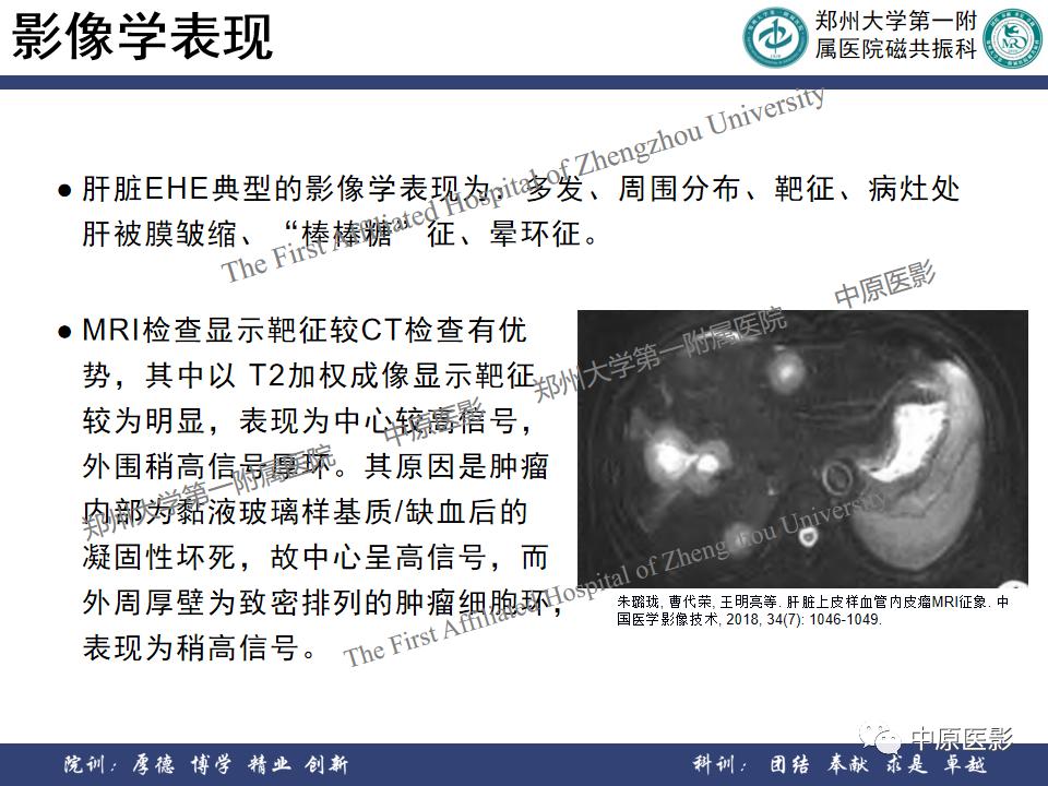 肝脏血管瘤样本,正确认识肝脏血管瘤文章