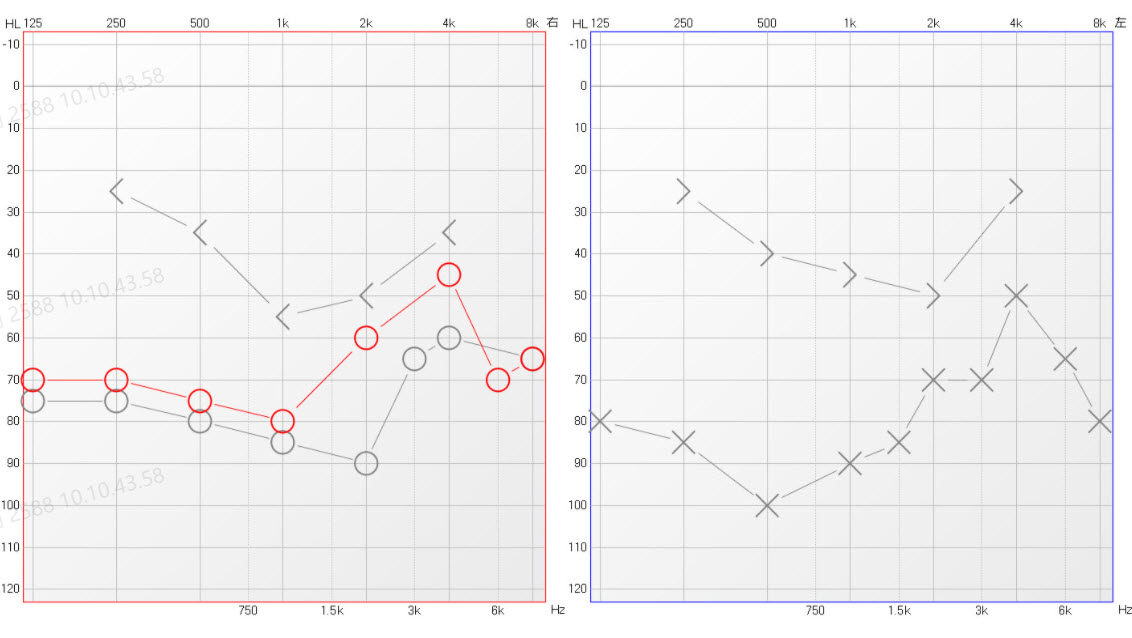 耳骨链断裂手术怎么做,听骨链重建和耳膜修复住院多久