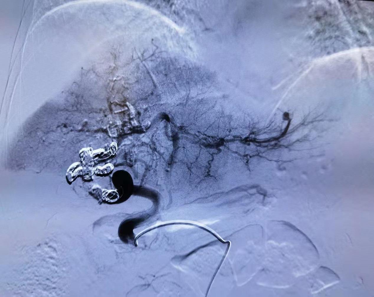 南昌大学二附院消化内科成功运用弹簧圈联合组织胶栓塞技术治疗一例高难度肝动脉-门静脉瘘患者