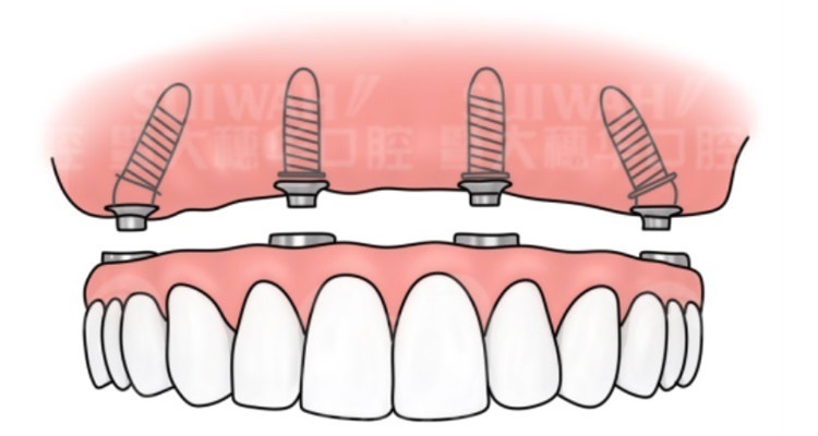 活动假牙的正确佩戴方法,活动假牙爱掉咋办