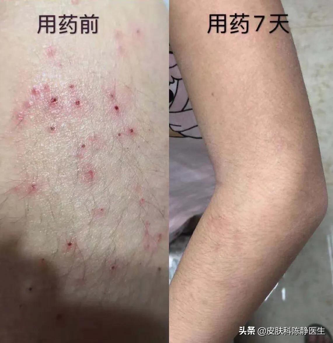 克立硼罗软膏是新药吗,克立硼罗软膏能治光敏性皮炎吗