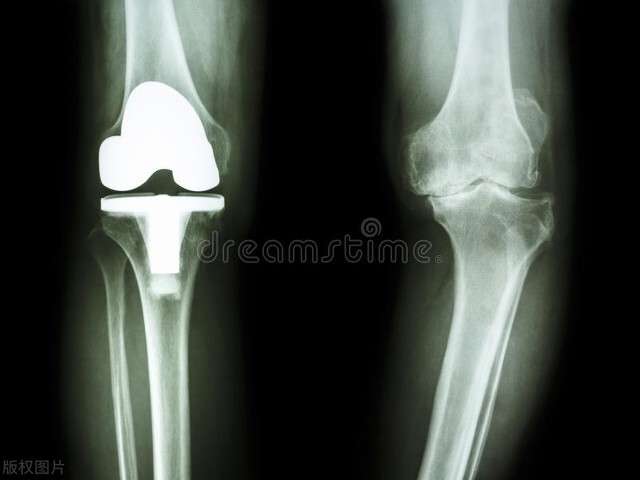 人工膝关节置换手术过程要多久,人工膝关节置换术后三个月