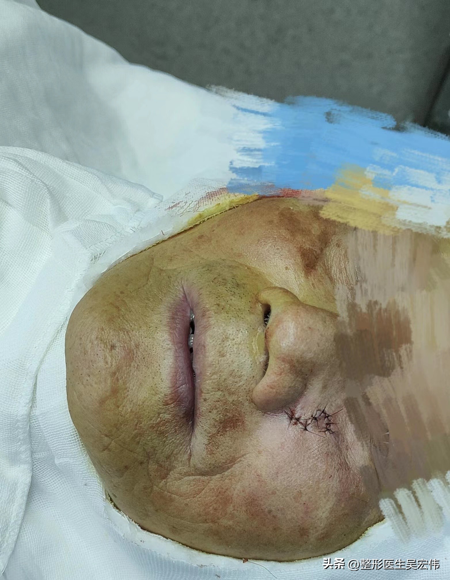 面部痣切除缝合不平整,面部痣可以去掉吗