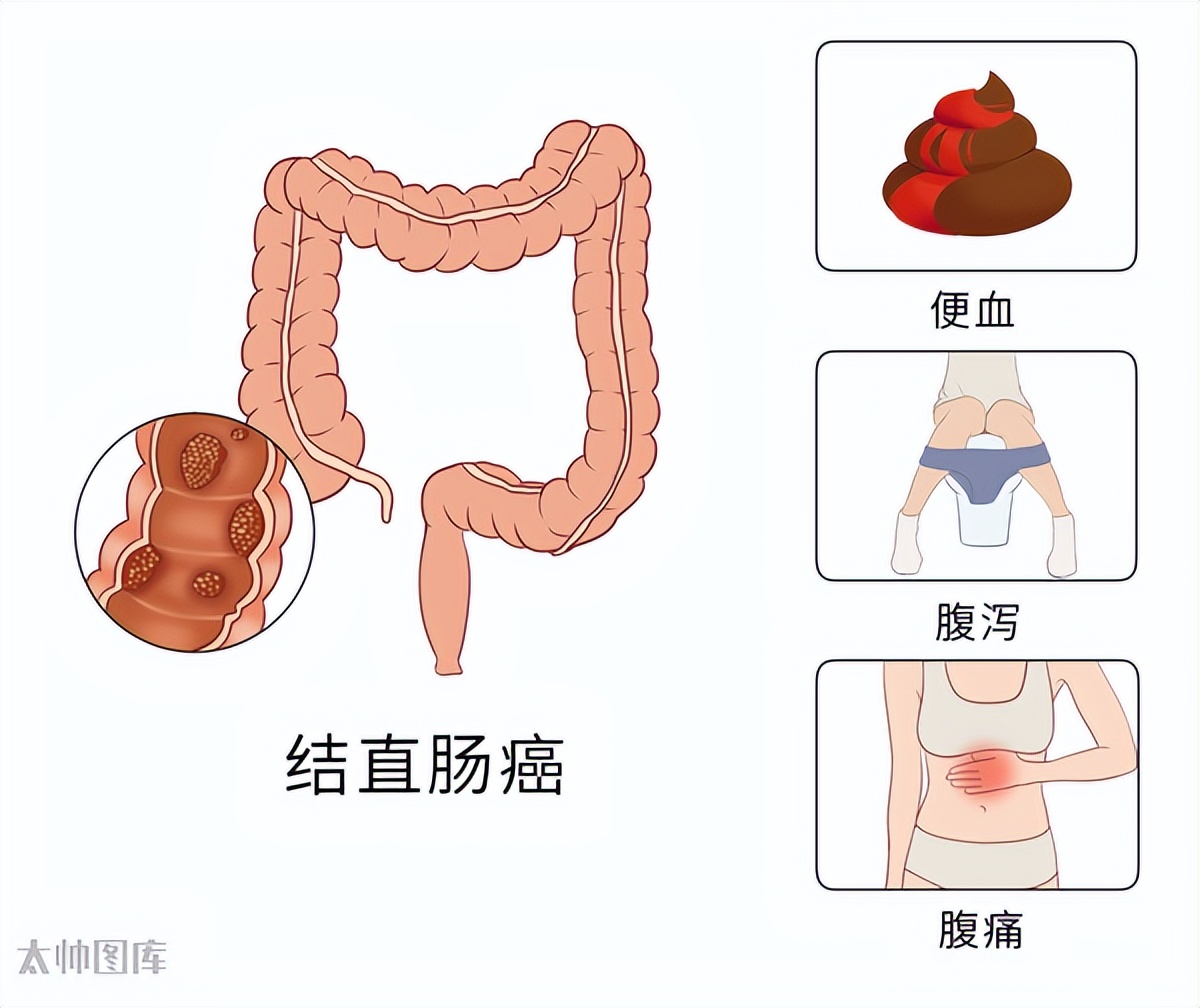 19种癌的早期信号和筛查建议——早知道能救命！