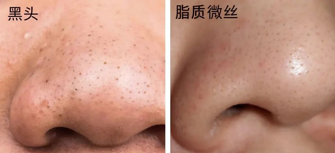 看不爽的黑头要这样对付它(二)方法篇