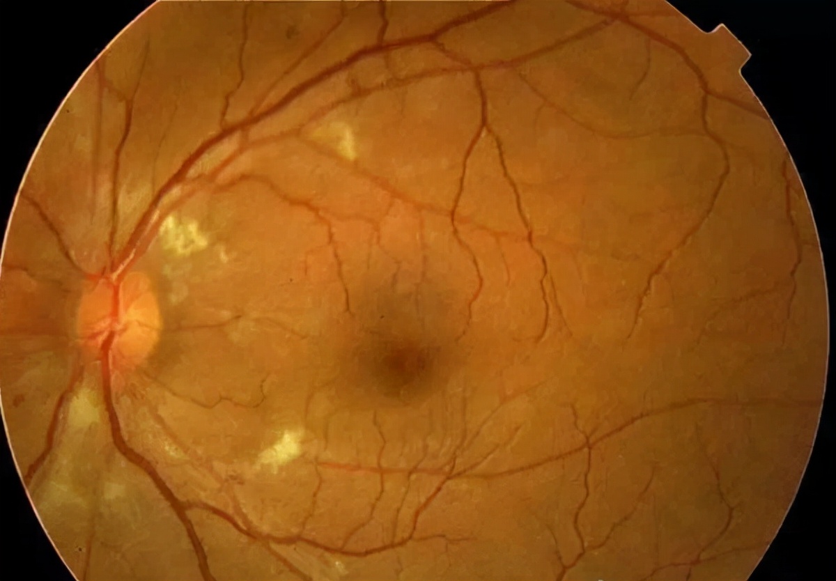 肾衰高血压引起的眼睛模糊怎么治,高血压肾衰竭会引起眼部看不见吗