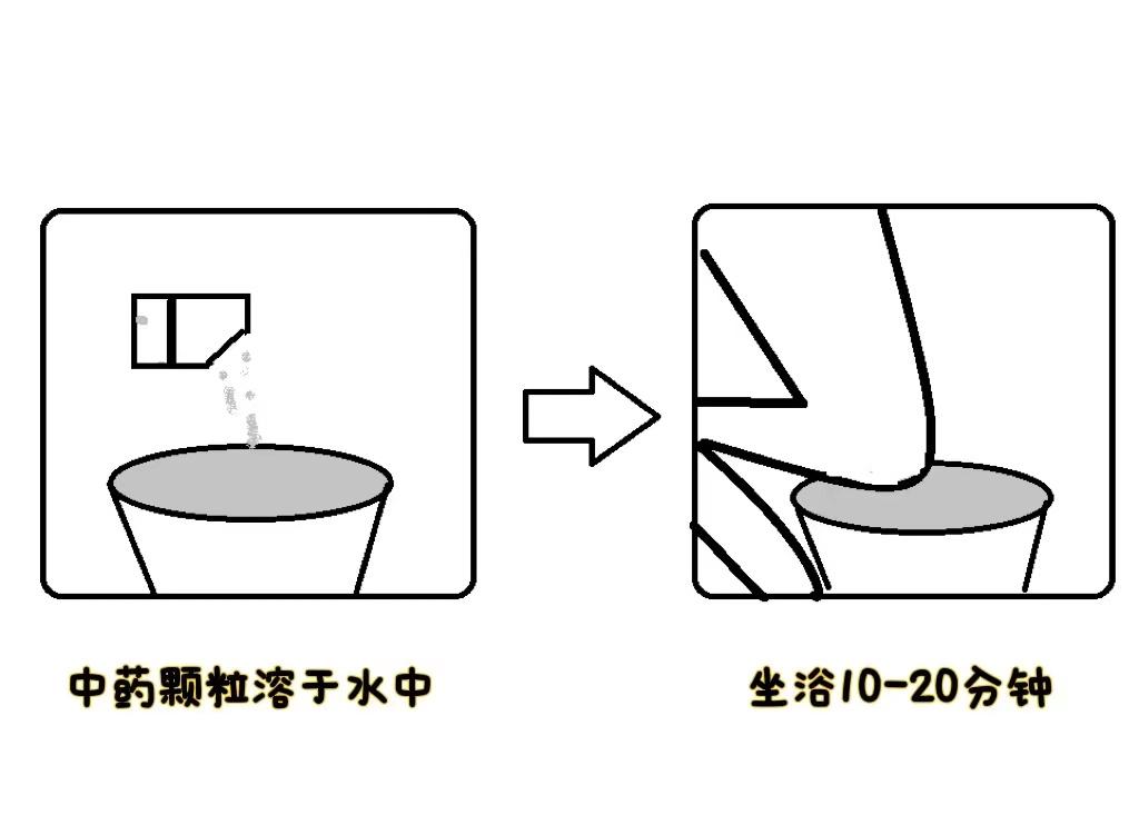 肛周脓肿被医生诊断痔疮,中医治疗肛门脓肿痔疮