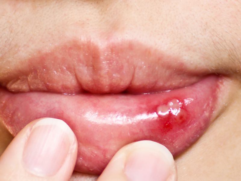 反复牙龈肿痛口舌生疮吃什么药,牙龈肿痛口舌生疮用什么药效果好