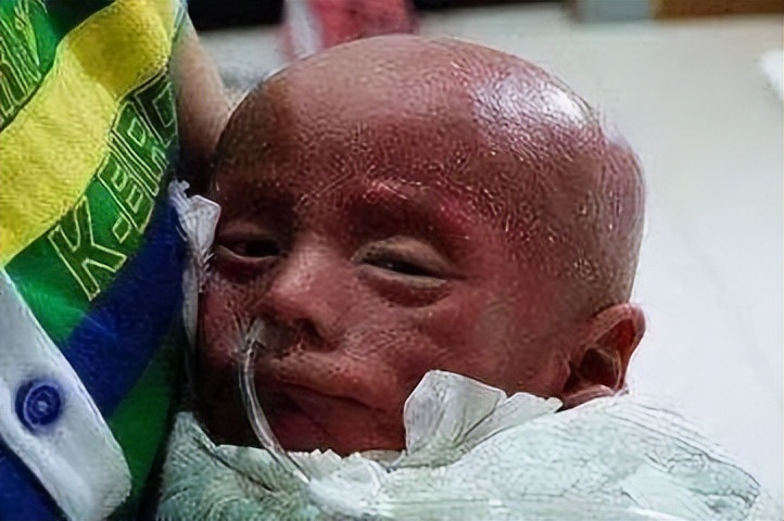 卡介苗最严重的异常反应,令人感染的肺炎疫苗