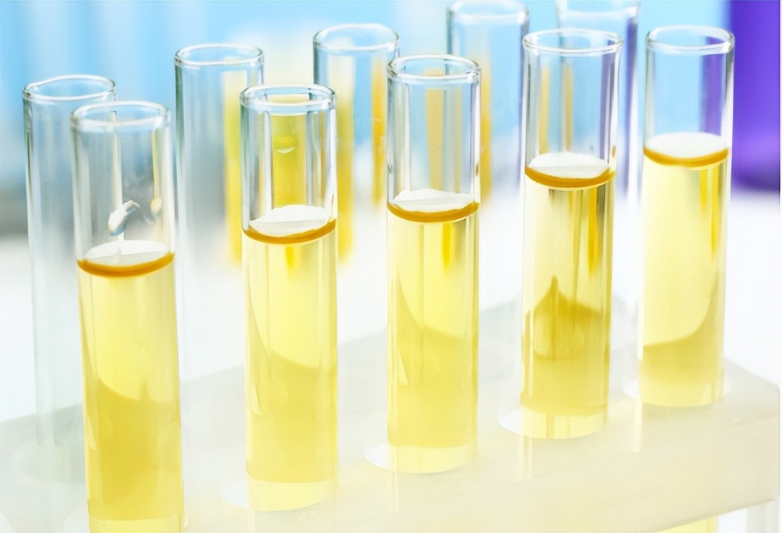 尿液柠檬黄是什么原因引起的,尿液黄泡沫多是什么原因