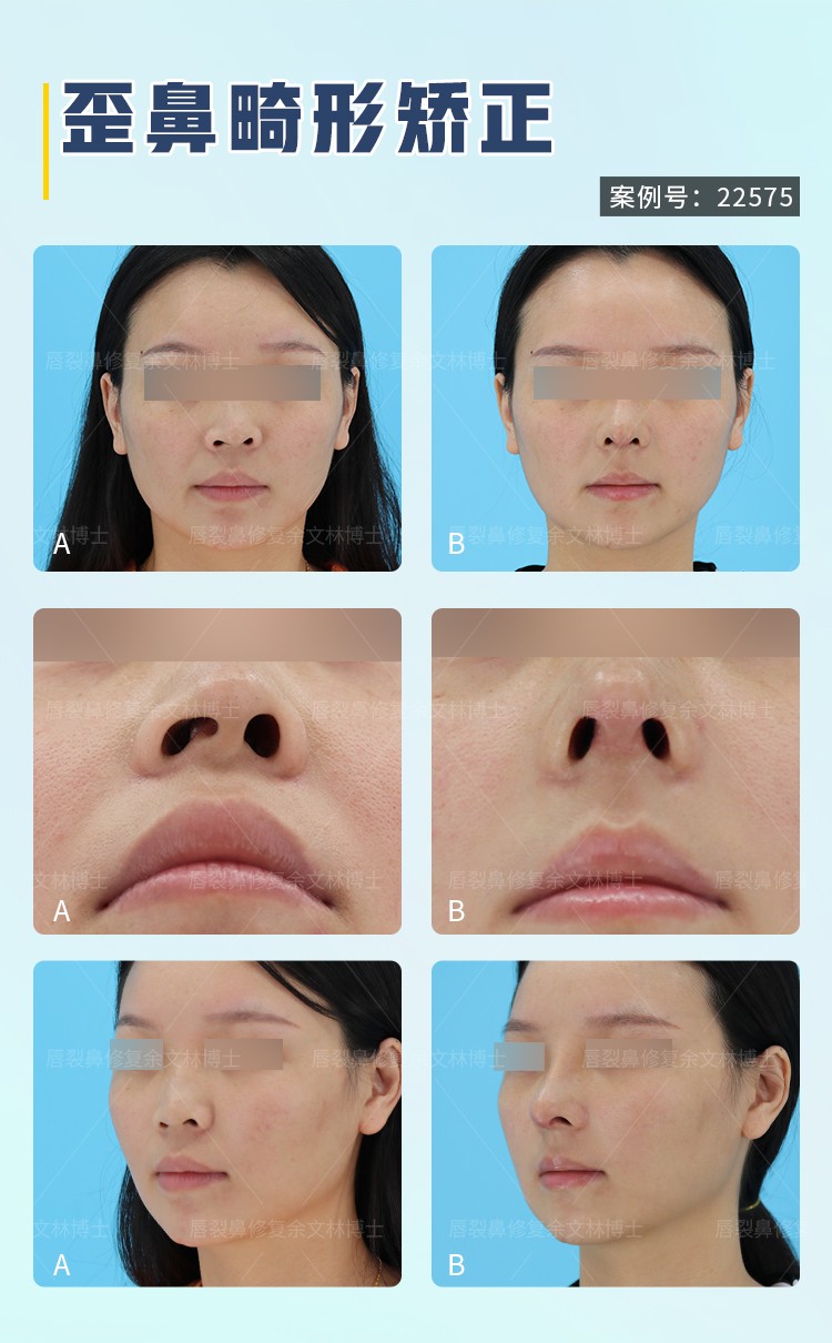 鼻子畸形堵住了怎么治？唇裂继发鼻畸形的患者可以这样做