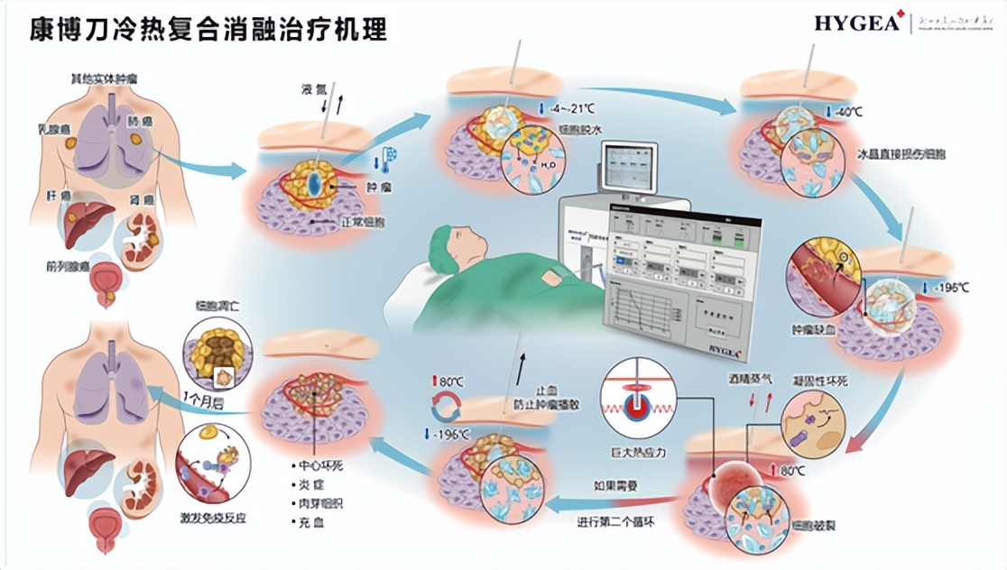 康博刀治疗肺癌一次要多少钱,康博刀能治肺部肿瘤
