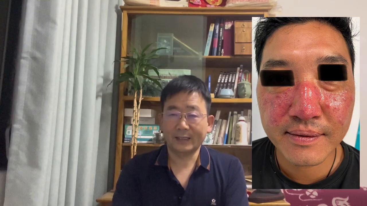 民间治愈玫瑰痤疮的偏方,治玫瑰痤疮的特效药