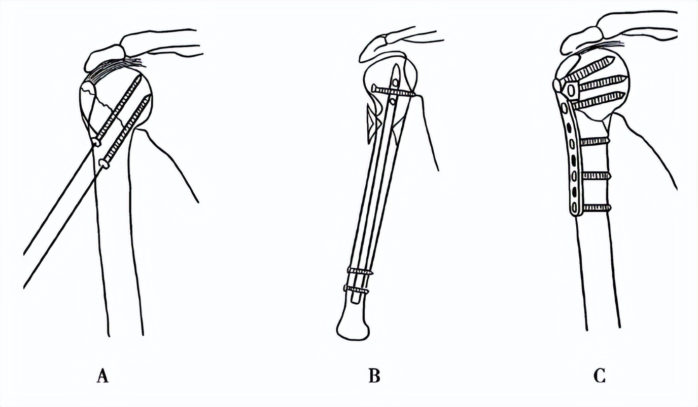 四个注意全面预防骨质疏松,4个要点的剖析