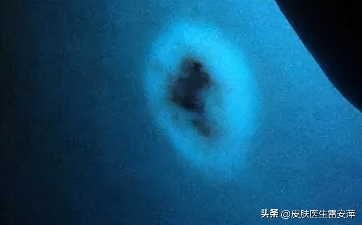 晕痣型白癜风怎么治疗,晕痣型白癜风治疗方法