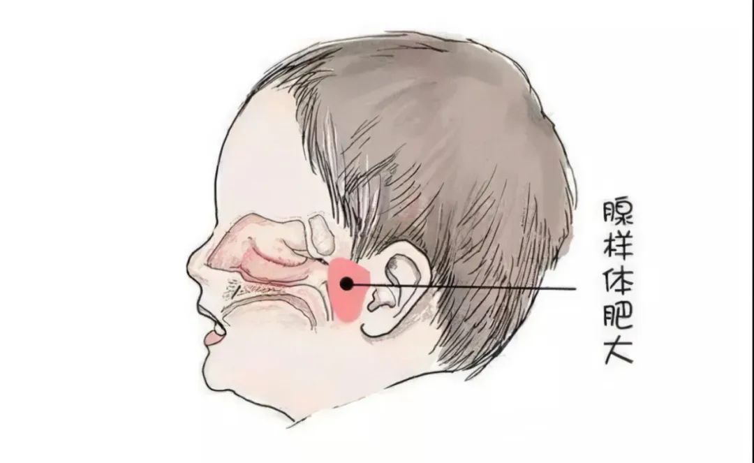 小儿鼾症术后饮食,鼾症术后护理要点