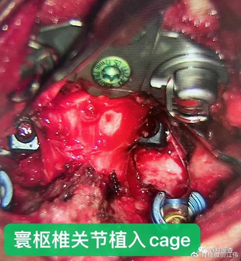 颅底凹陷症齿状突半脱位,颅底手术新突破