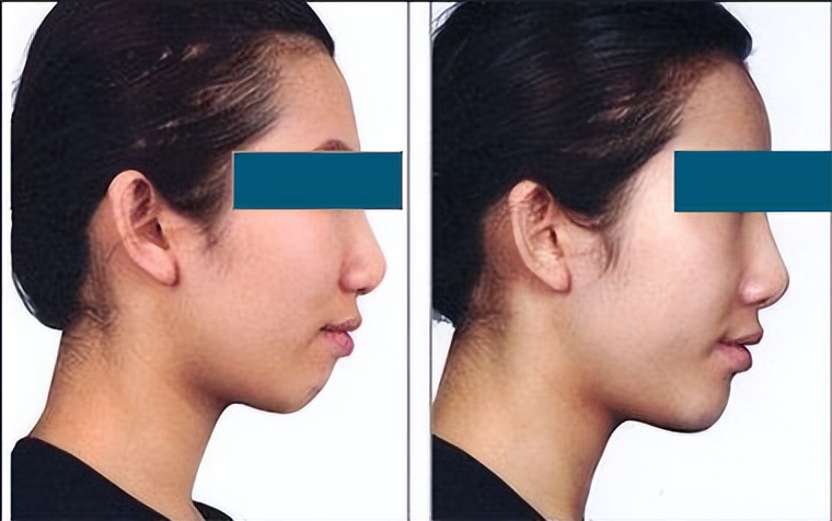 下巴后缩是不是最难看的,下巴后缩明星怎么改善