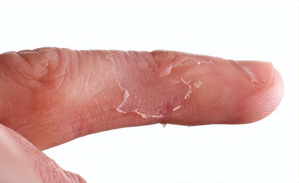 怎样防手干燥脱皮,换季手脱皮怎样治