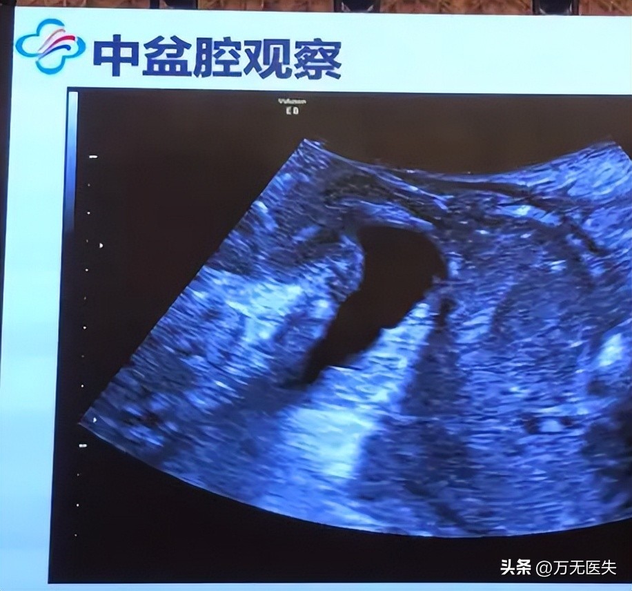 一位单身女士提醒：做妇科体检前，一定要禁欲，否则会非常尴尬