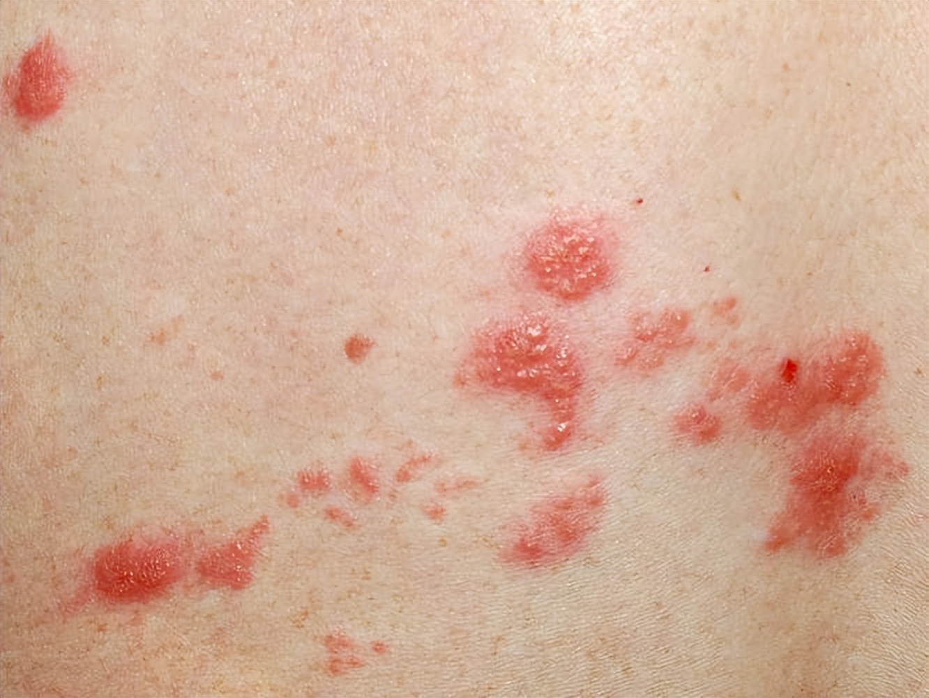 带状疱疹又叫“缠腰蛇”，该怎么治？医生：这10类人易被盯上！