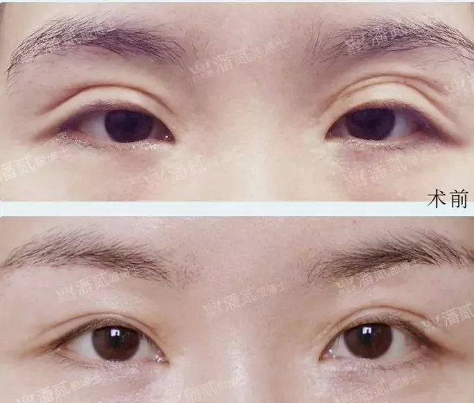 眼窝凹陷是什么症状,眼窝凹陷的改善方法有哪些