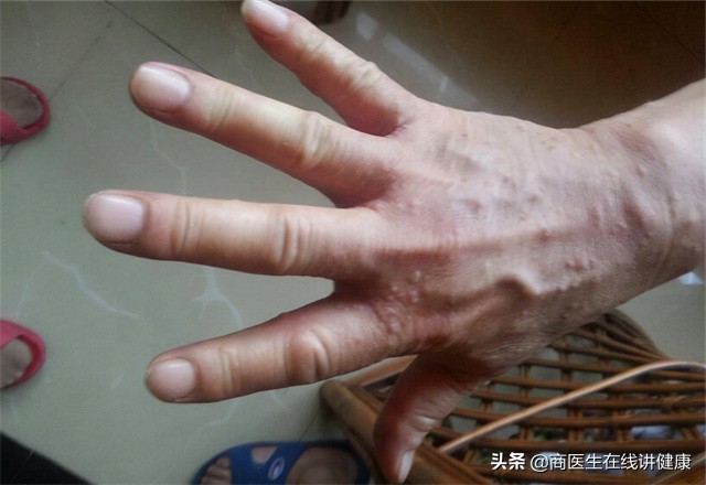 疥螨怎么引起的,疥螨是如何感染上的