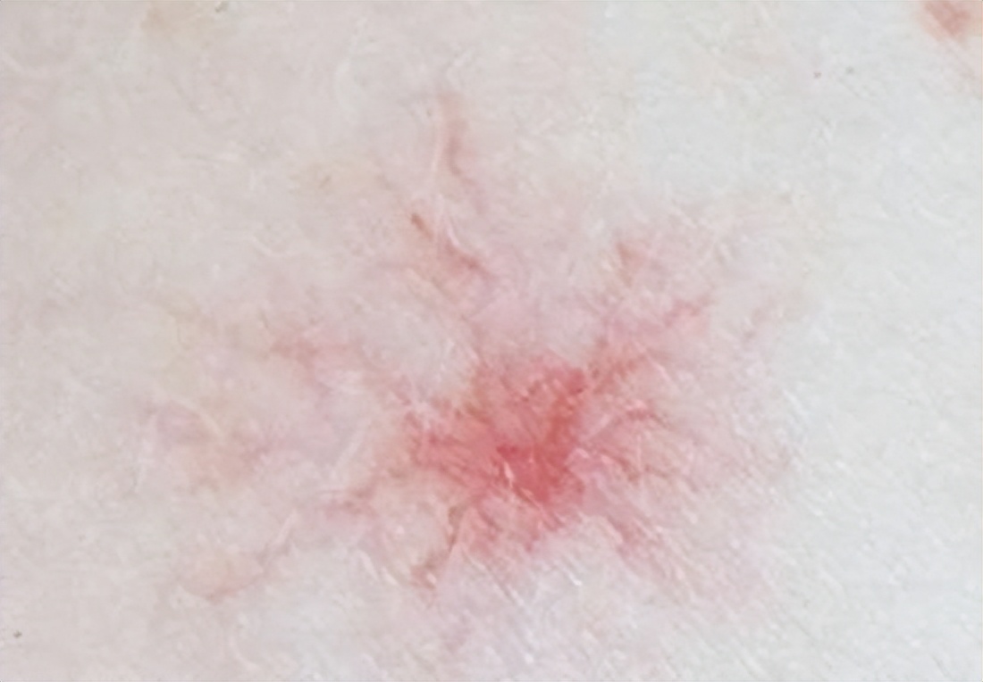 【豫健中医】药膳坊：脸上出现“*血丝红**”要注意了