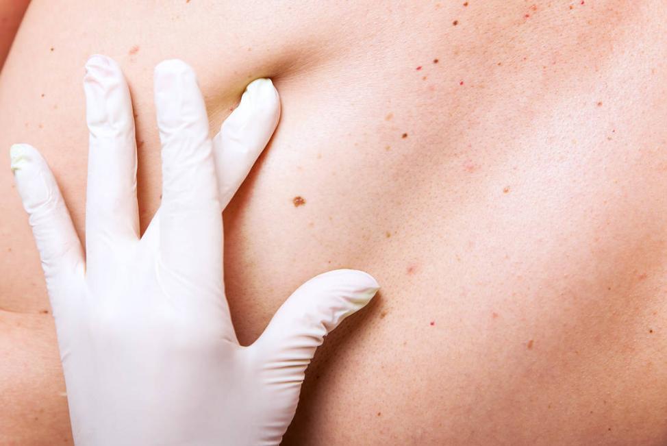 警惕这些痣可能会成瘤,哪些地方有痣代表得癌症了