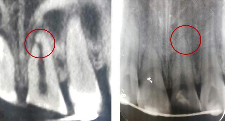 牙齿受外伤吃什么对牙好,牙齿受损伤引起牙痛怎么办