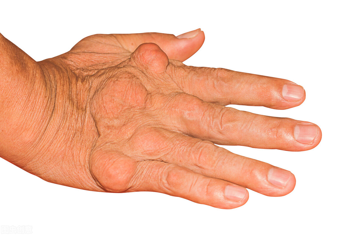 痛风药非布司他是不是处方药,非布司他药治痛风效果怎么样