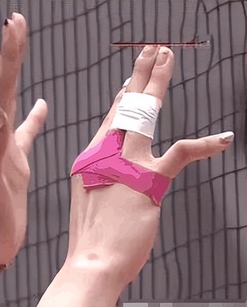 骨折之后有大量骨痂是完全好了吗,骨折后不疼了是不是好了