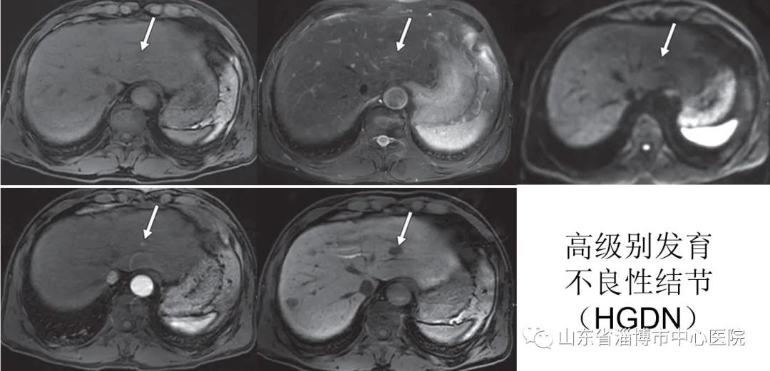 肝胆特异性对比剂检查的意义,肝胆特异性对比剂影像表现