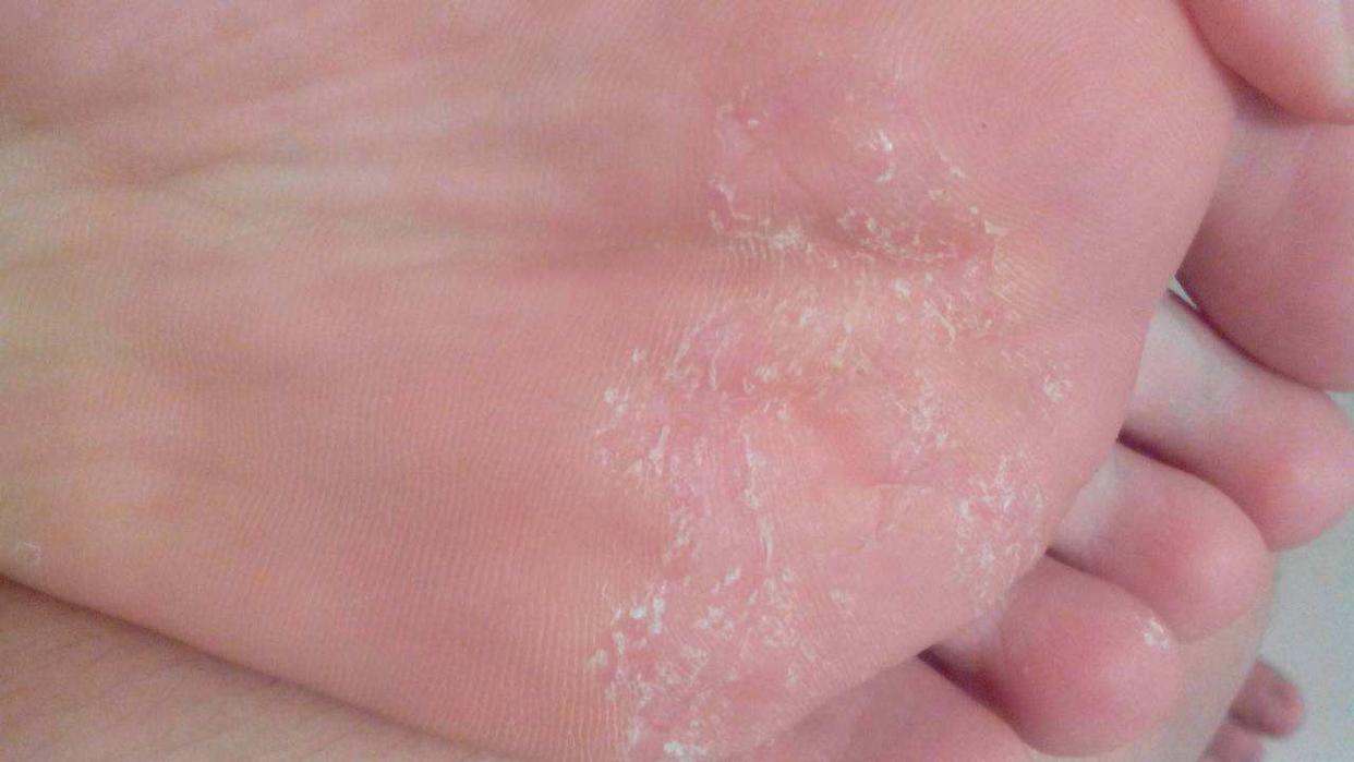 hpv感染意味着什么,hpv感染了皮肤会出现什么症状