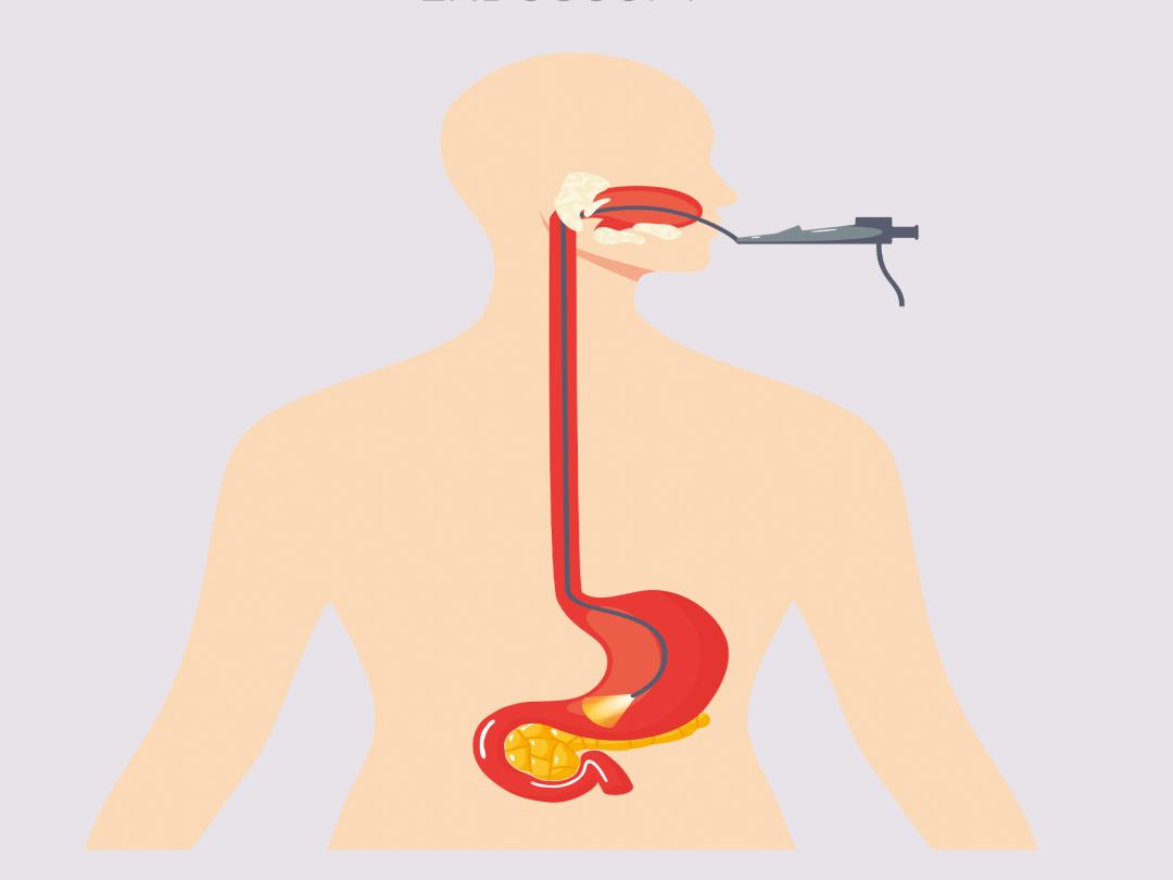 做一次胃镜对胃有多大伤害,胃镜多长时间做一次合理