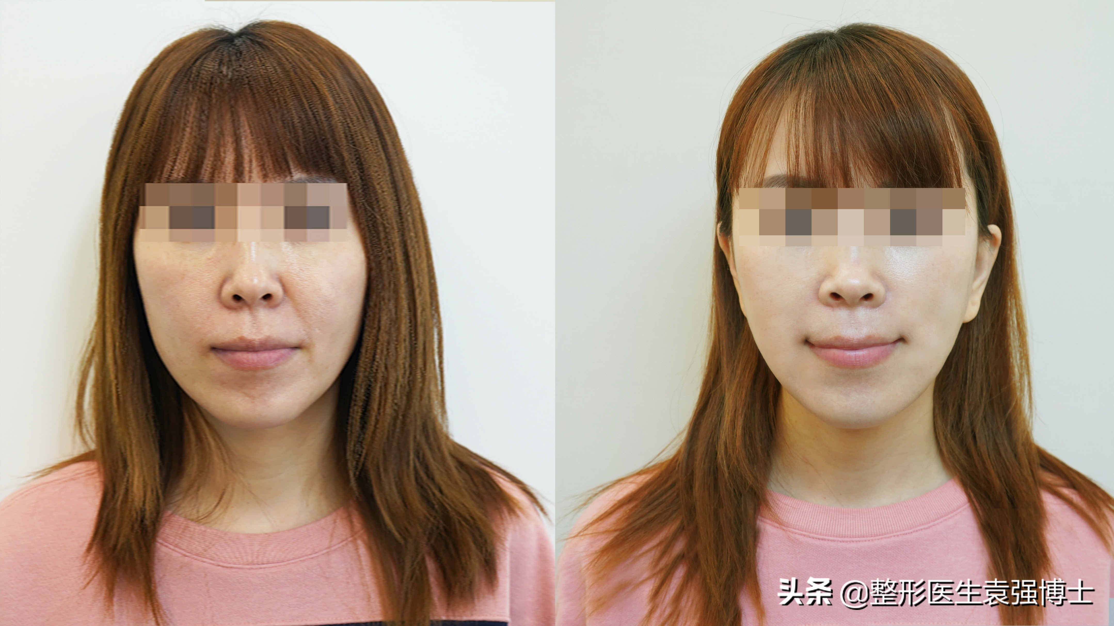 有什么办法能解决法令纹,有法令纹最好的解决办法真实有效