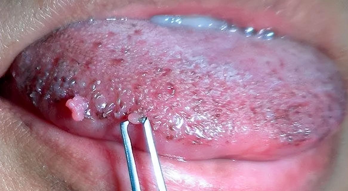 怎么确定口腔处有尖锐性湿疣,怎么判断是不是口腔尖锐性湿疣