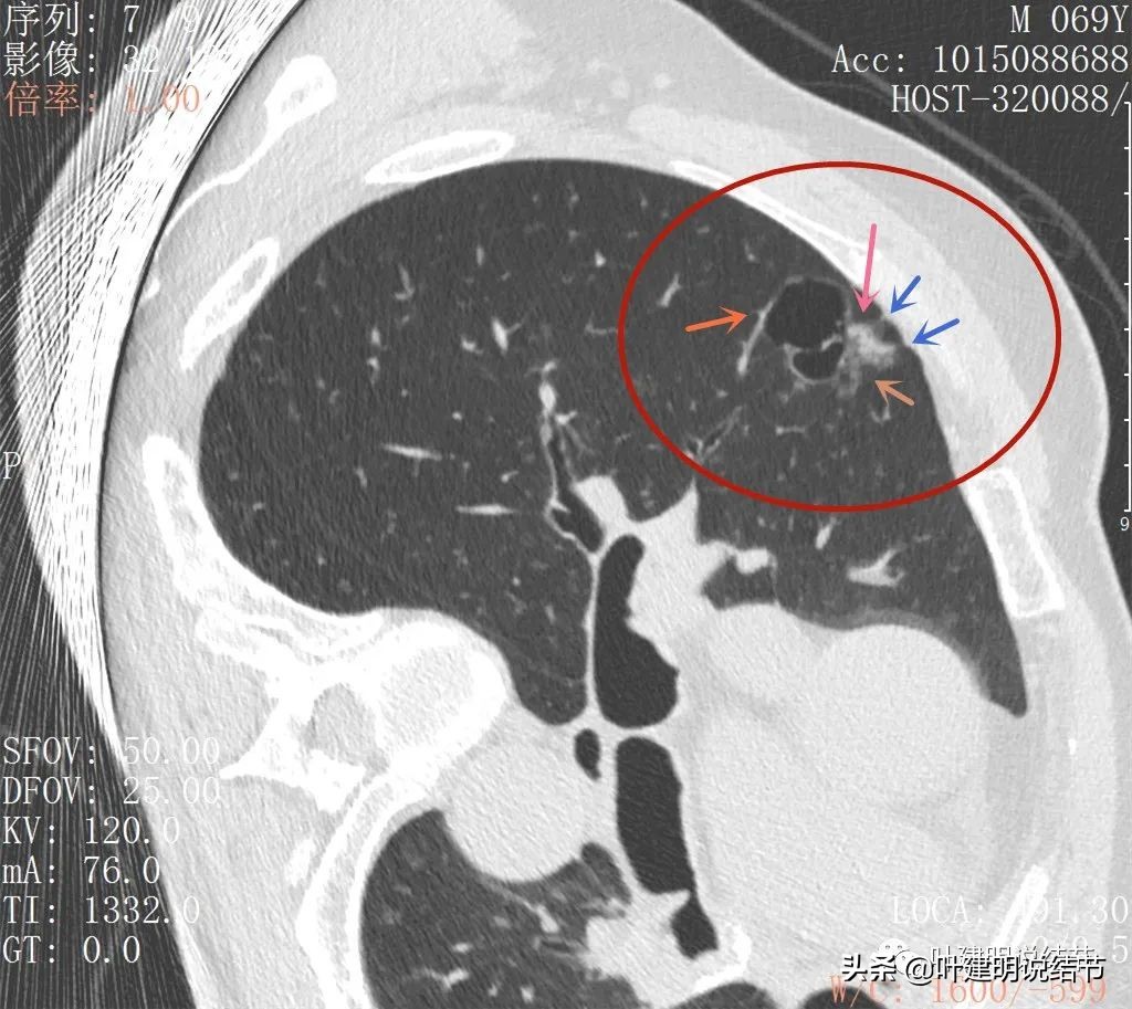 肺多发结节切除一个剩下的怎么办,无限纠结的肺小结节